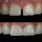 How Composite Bonding Can Transform Your Smile in Just One Visit