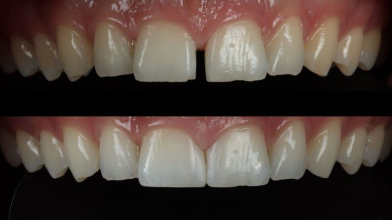 How Composite Bonding Can Transform Your Smile in Just One Visit